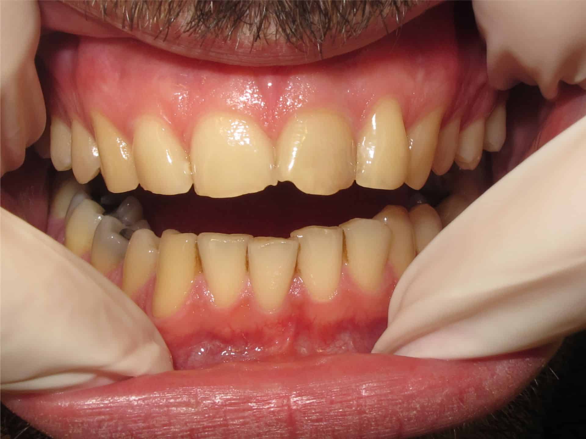 Faccette dentali Dental Centar Ostojić Faccette dentali Dental Centar Ostojić